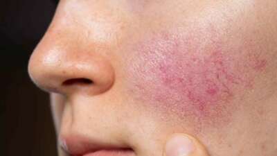 Gül hastalığı ihmal edilmemeli