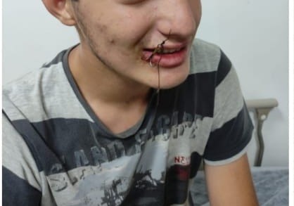 Bu kez oltaya çocuk takıldı Bursa’nın Yenişehir ilçesinde ağzına