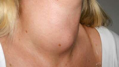  Boynunuzda şişlik varsa dikkat