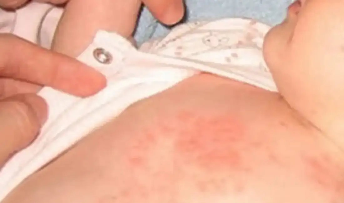 Sıcaklar çocuklarda isilik alarmı veriyor Doruk Nilüfer Hastanesi Çocuk