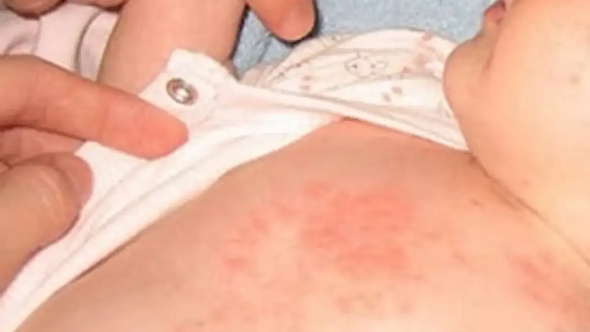 Sıcaklar çocuklarda isilik alarmı veriyor