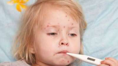 Ateş, halsizlik ve döküntülerle kendini