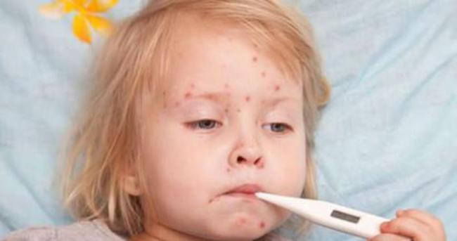 Ateş, halsizlik ve döküntülerle