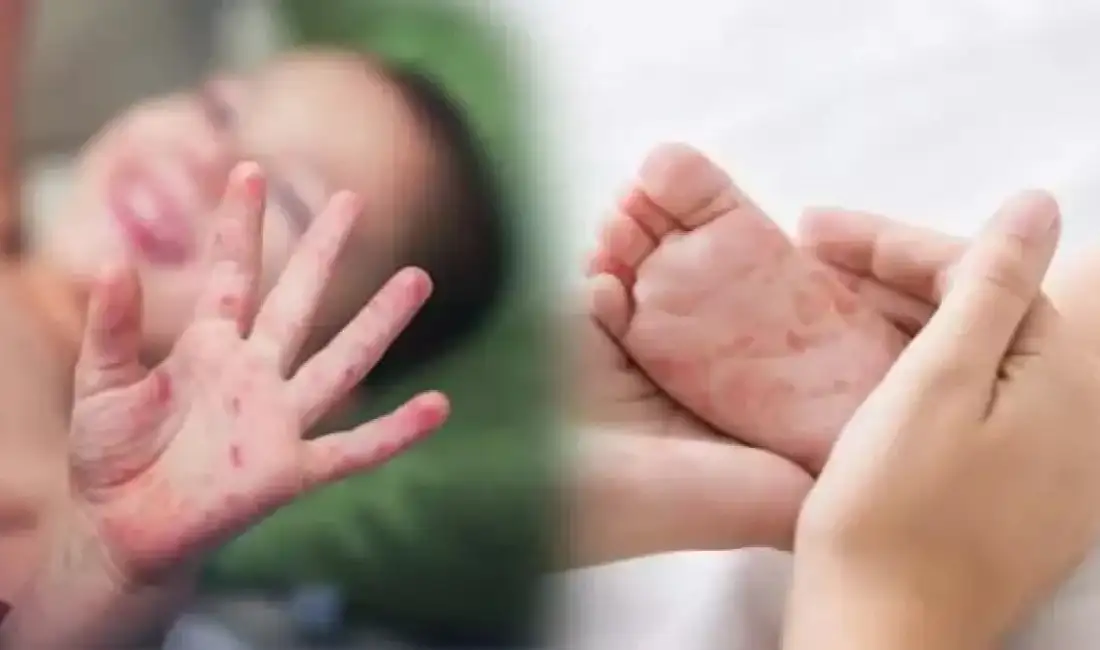 Çocuklarda el, ayak ve ağız hastalığı vakaları artıyor Çocuklarda son dönemde artış