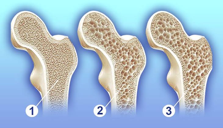 Sessiz ilerleyen hastalık osteoporoz Burtom Konur Cerrahi Tıp